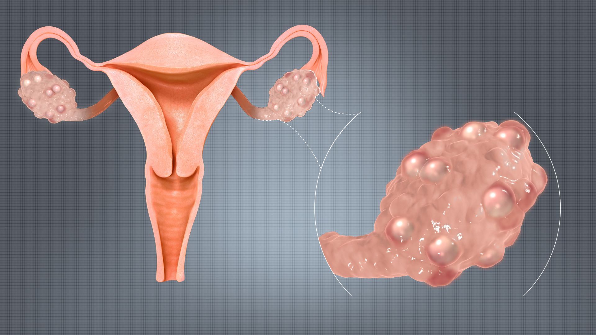 PCOS (syndrom polycystických ovarií) - co signalizuje, jaké má příznaky a jak jej řešit
