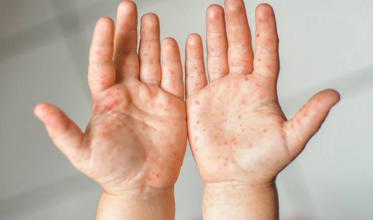 Co je Addisonova nemoc u dětí a jak ji léčit