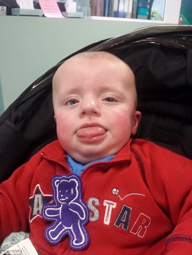 Co je Beckwith-Wiedemannův syndrom a jak ho léčit