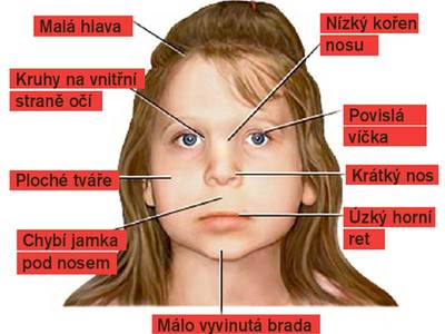 Co je Charge syndrom u dětí a jak ho léčit