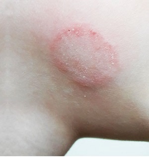 Co je dermatofytóza (kožní plísně) u dětí a jak ji léčit