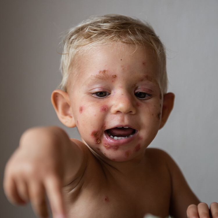 Co je impetigo u dětí a jak ji léčit