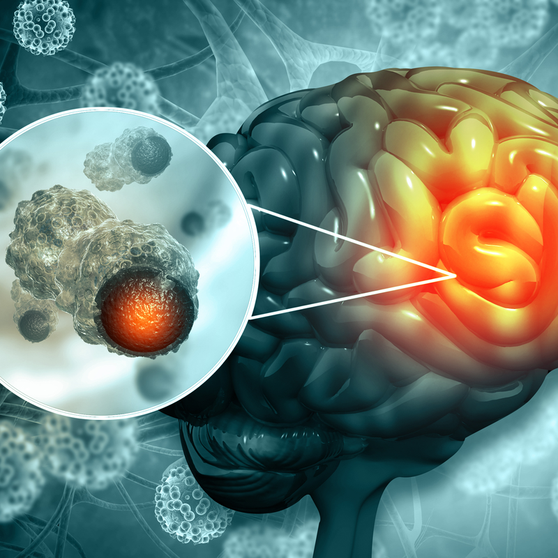 Co je meduloblastom u dětí a jak ho léčit