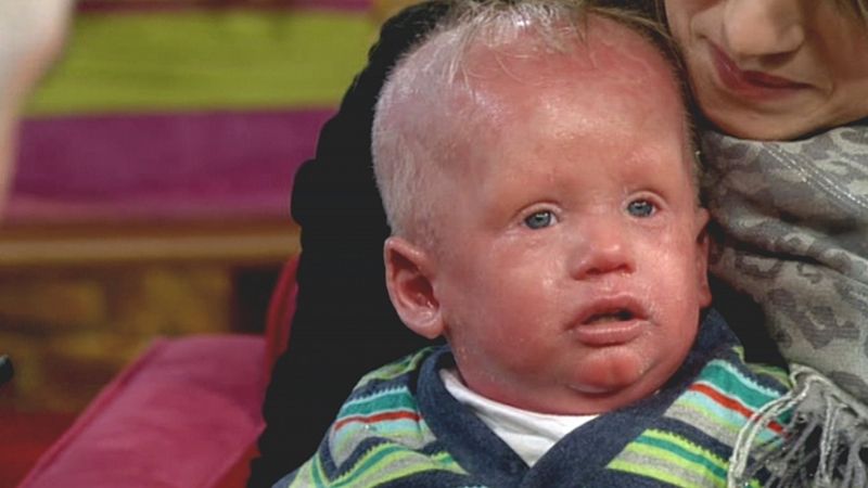 Co je Nethertonův syndrom u dětí a jak ho léčit