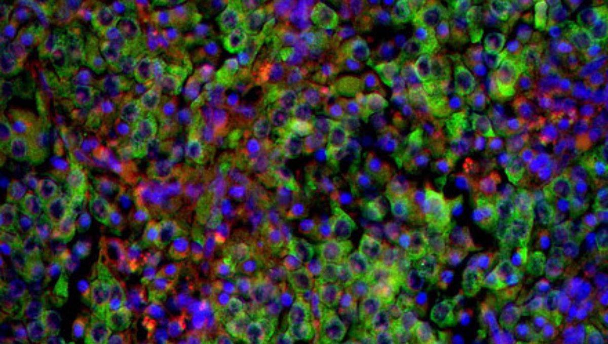 Co je neuroblastom u dětí a jak ho léčit
