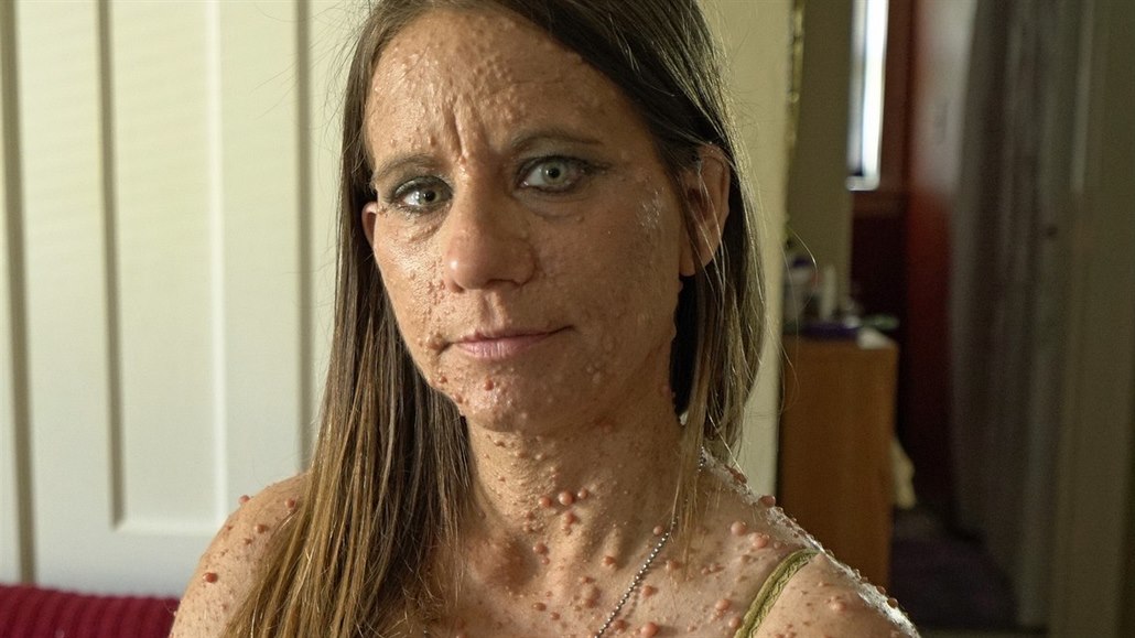 Co je Neurofibromatóza u dětí a jak ho léčit