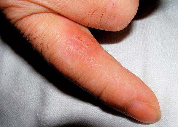 Co je tularémie u dětí a jak ji léčit