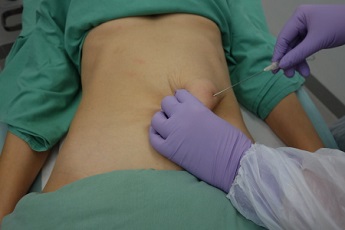 Tumescentní liposukce je klasická technika, která vás zbaví přebytečného tuku spolehlivě a bezpečně