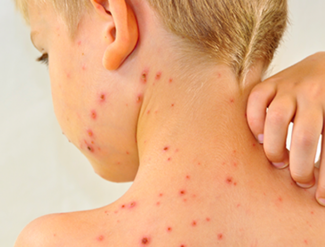 Spalničky u dětí: Jak se léčí?