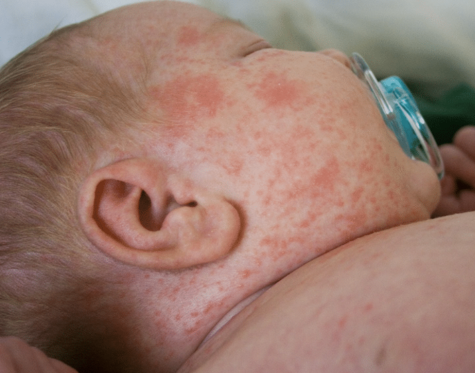 Co jsou potničky u dětí?