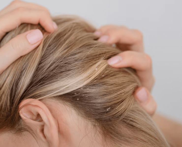 Seborea ve vlasech: Jak s ní účinně bojovat