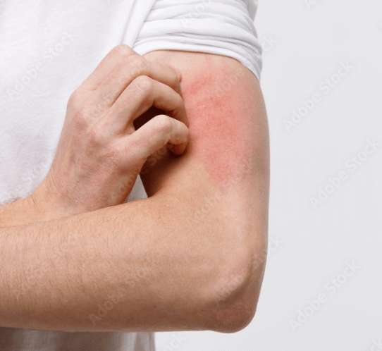 Svrab: Jak se léčí a jaká je prevence