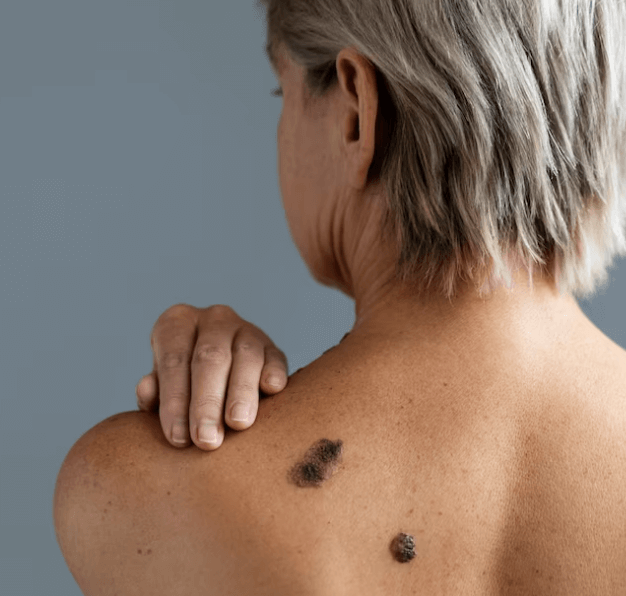 Jak odstranit plíseň na zádech a jak vzniká