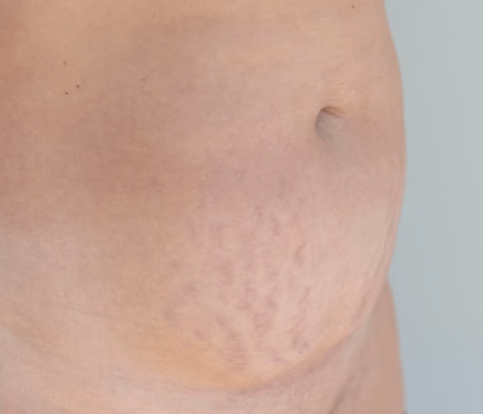 Co znamená diastáze a jak se řeší