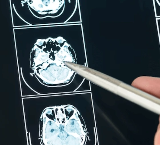 Co je hypodenzita: Vysvětlení a význam