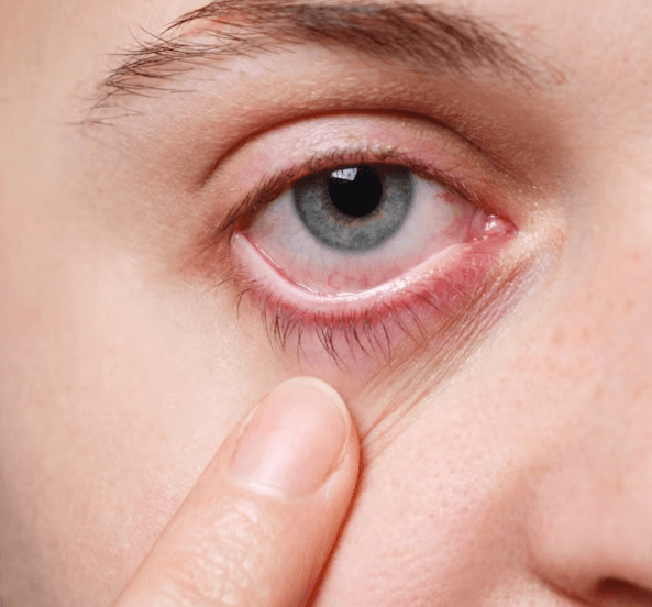 Prasklá žilka v oku - co je příčinou a co dělat