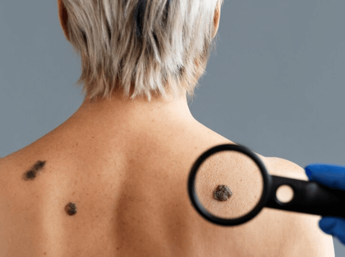 Jak vypadá rakovina kůže: Identifikace a známky