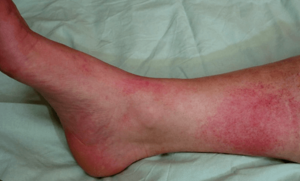 Co je streptokok a zlatý streptokok: Přehled bakterií