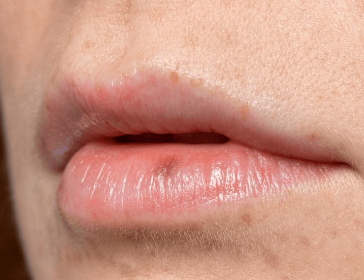 Jak léčit pásový opar: Rady pro účinnou léčbu