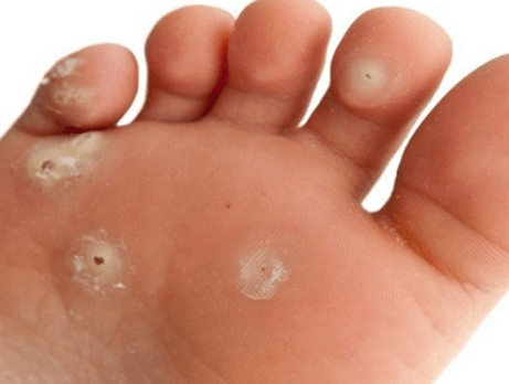 Jak se zbavit kuřího oka: Domácí léčba a prevence