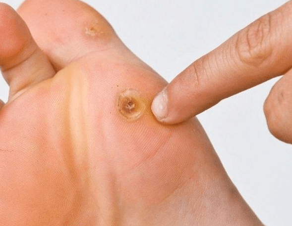 Jak na bradavice: Domácí léčba a odstranění
