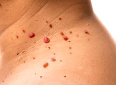 Jak odstranit papilomy: Metody a bezpečnostní rady