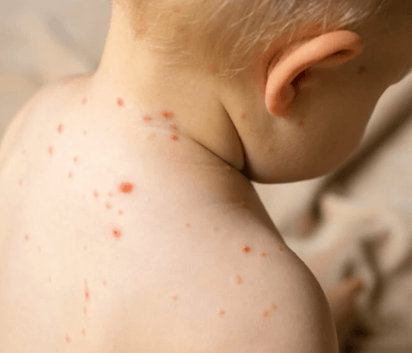 Jak vypadají neštovice u dětí a jaké jsou příznaky a projevy?
