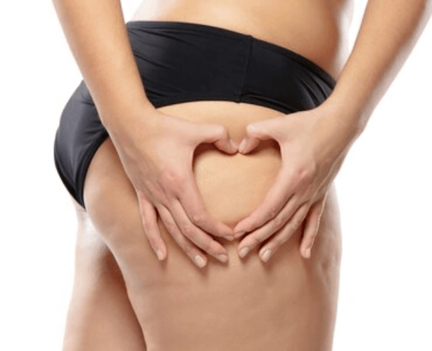 Jak se zbavit celulitidy navždy – Osvědčené tipy a triky