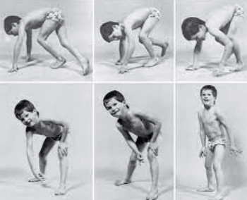 Co je Beckerova muskulární dystrofie a jak se léčí