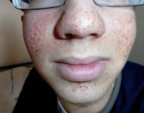 Co je Tuberózní skleróza a jak se léčí