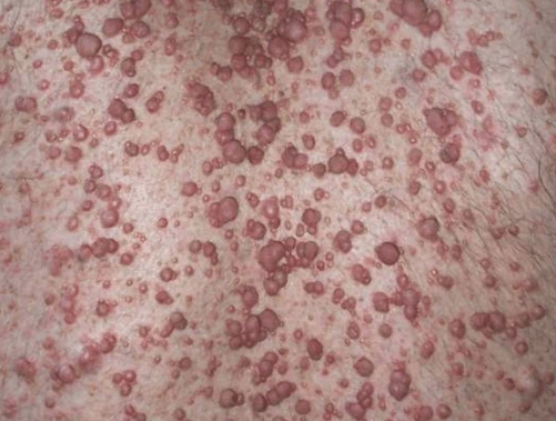 Co je Neurofibromatóza a jak se léčí