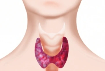 Co je Hypothyreóza a jak se léčí