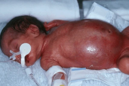 Co je Necrotizing enterocolitis (NEC) a jak se léčí