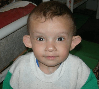 Co je Russell-Silverův syndrom u dětí a jak se léčí