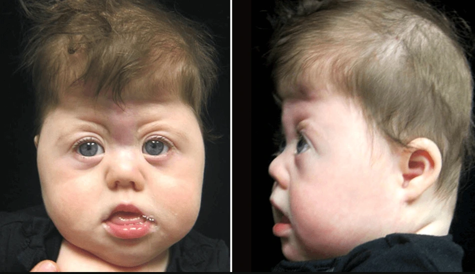 Co je Saethre-Chotzenův syndrom u dětí a jak se léčí