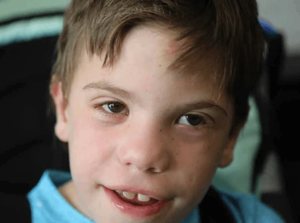 Co je Smith-Lemli-Opitzův syndrom u dětí a jak se léčí