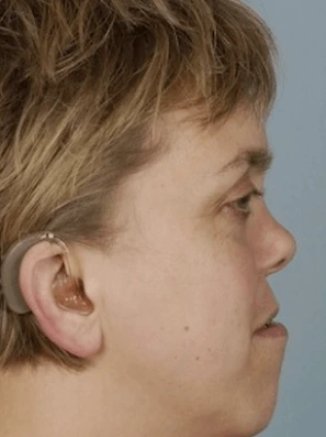 Co je Sticklerův syndrom u dětí a jak se léčí