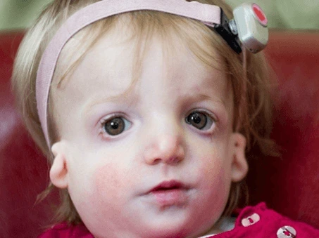 Co je Treacher Collinsův syndrom u dětí a jak se léčí