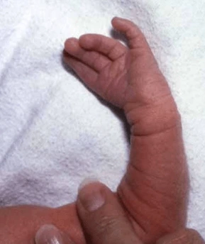 Co je VATER/VACTERL asociace u dětí a jak se léčí