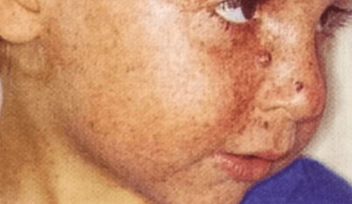 Co je Xeroderma pigmentosum u dětí a jak se léčí