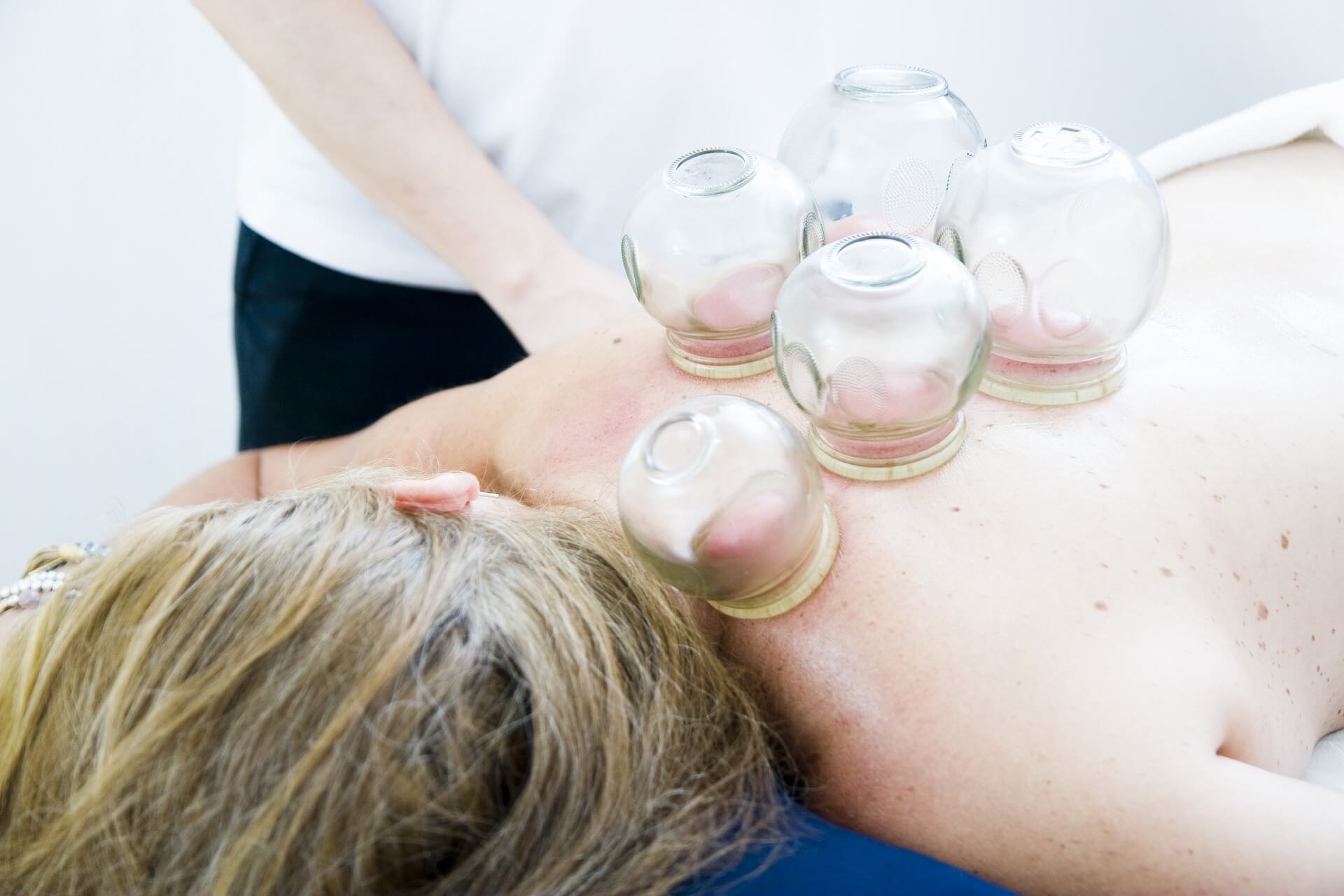cupping-therapy-gb31010907_1920