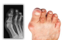 Hallux valgus, vbočený palec