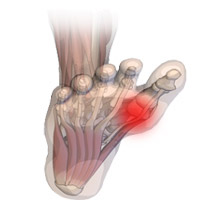 Sesamoiditis