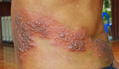 Guertelrose-Herpes-zoster