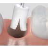 Common oral surgery cone2