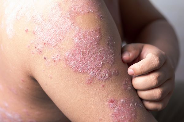 Men are using his hands to scratch the arm ulcers. Diseases caused by abnormalities of the lymph. Psoriasis is a skin disease.