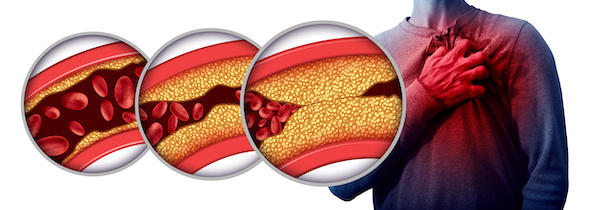 Proč je cholesterol špatný?
