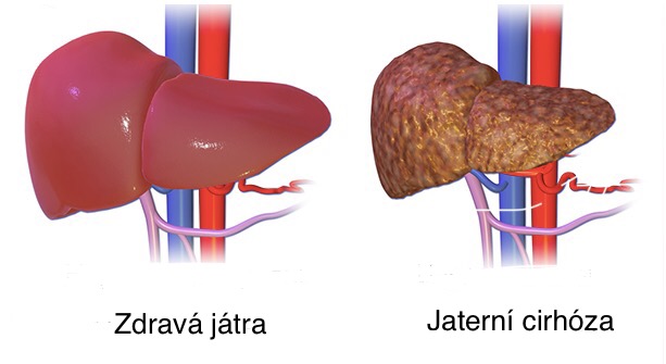Jak vypadají nemocná a zdravá játra?