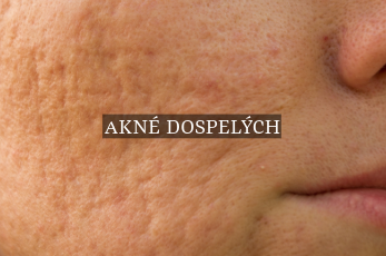 Akné dospelých