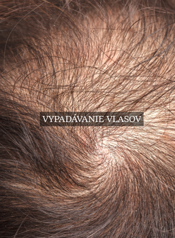 Vypadávanie vlasov, riedke vlasy